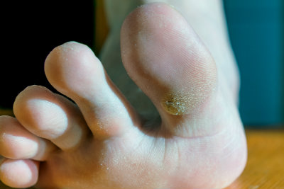 wart on foot infected)