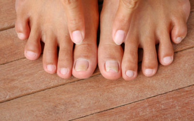 What Increases the Risk of Fungal Toenails